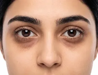 علت تیرگی و پف زیر چشم چیست؟