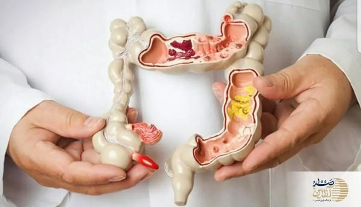 علائم اولیه سرطان روده بزرگ را بشناسید