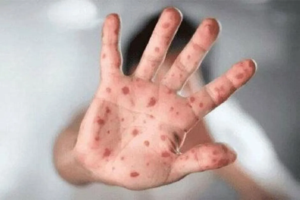 مینو محرز: یک سال‌ونیم پیش بیمار مبتلا به آبله میمونی داشتم