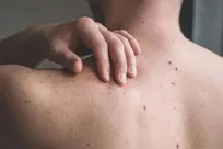 آیا این مشکل پوستی شما بی‌خطر است یا خطرناک؟ / نشانه‌هایی که باید به متخصص مراجعه کنید