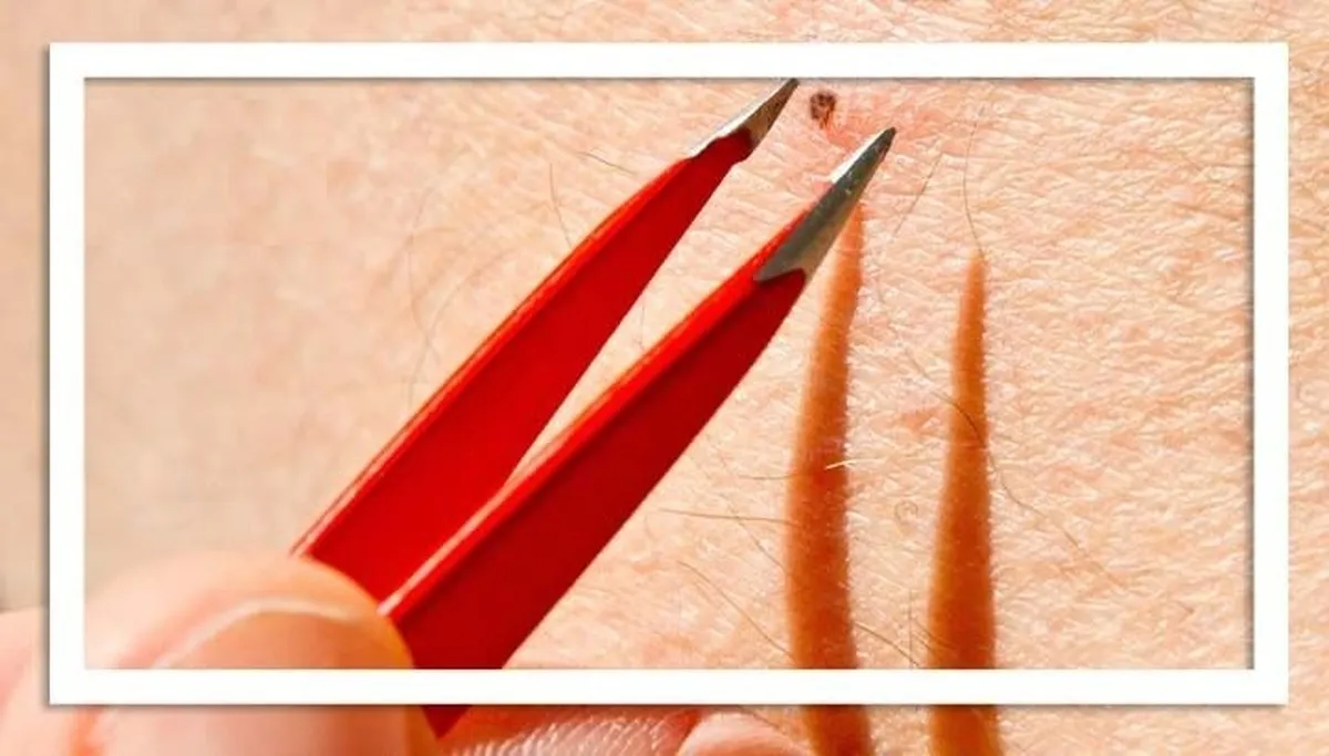 بهترین روش برای خلاصی از موهای زیر پوستی