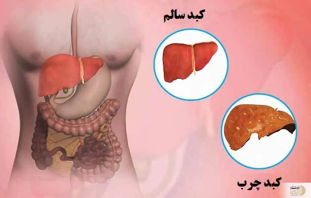 بهترین روش تشخیص کبد چرب و درمان قطعی از زبان پزشک سنتی