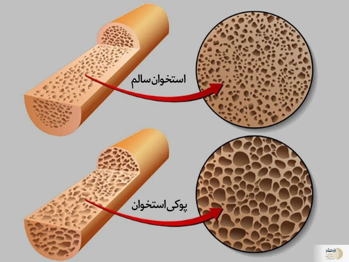 اگر استخوان فولادی می خواهید این ۲ ویتامین را مصرف کنید