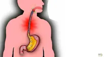 اثر عجیب و باور نکردنی پوشیدن لباس تنگ روی رفلاکس معده + عکس