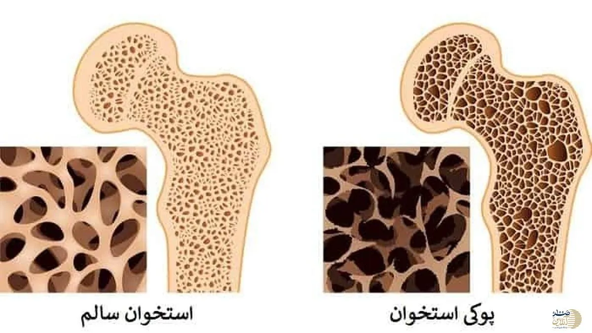 ویدیو/ این ترکیب شگفت انگیز قاتل پوکی استخوان است