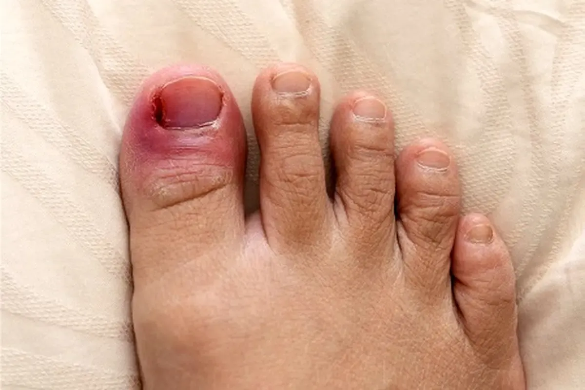 علل و نشانه های بروز عفونت ناخن پا