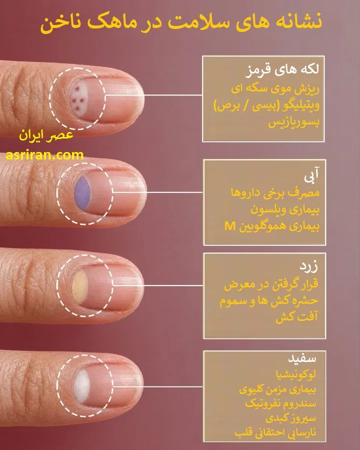 اینفوگرافیک نشانه های سلامت در ماهک ناخن اینفوگرافیک نشانه های سلامت در ماهک ناخن