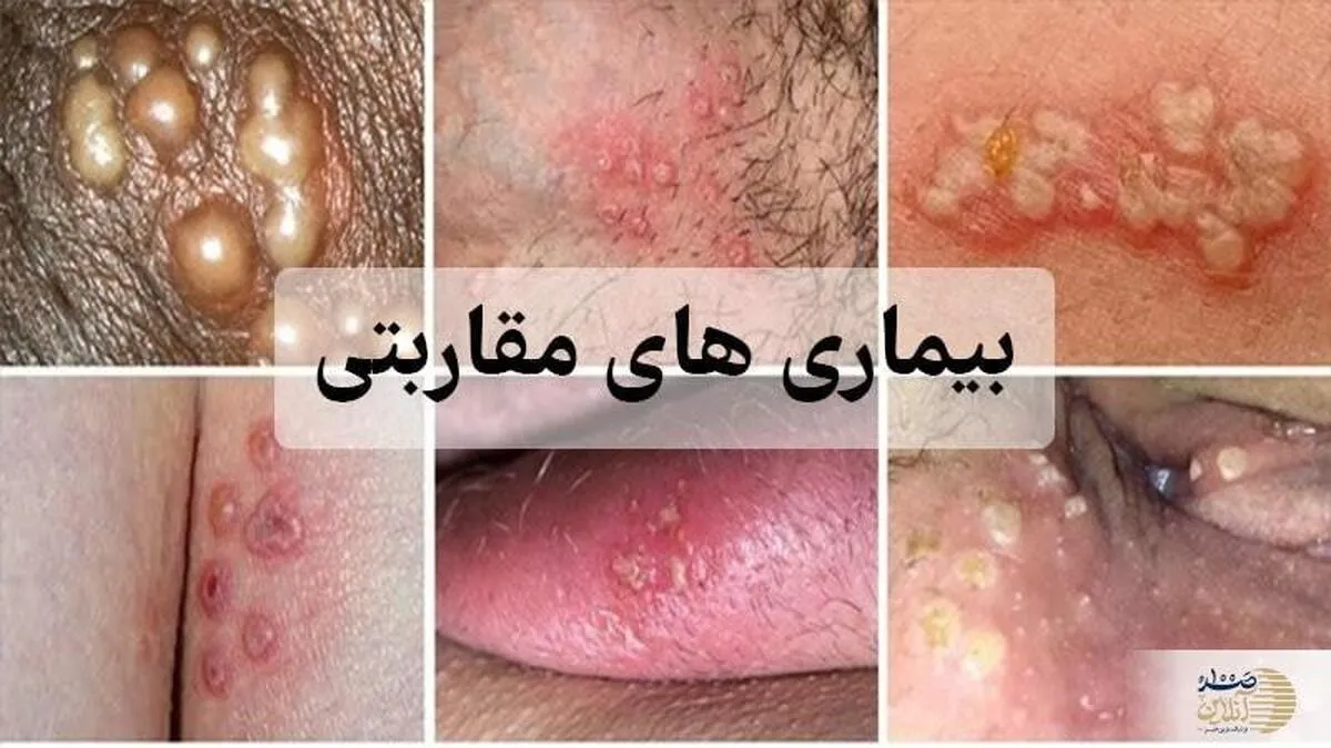 بشنوید: با تمام بیماری‌های مقاربتی آشنا شوید/ چگونه منتقل می‌شود؟